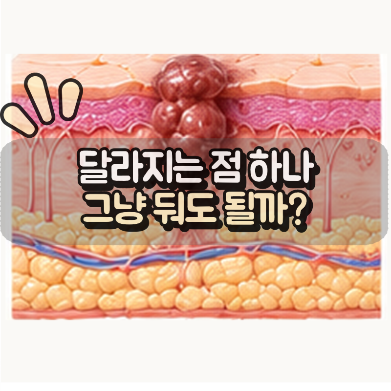 “점이 갑자기 커지고 달라졌다면?” 피부암에서 확인해야 할 변화들