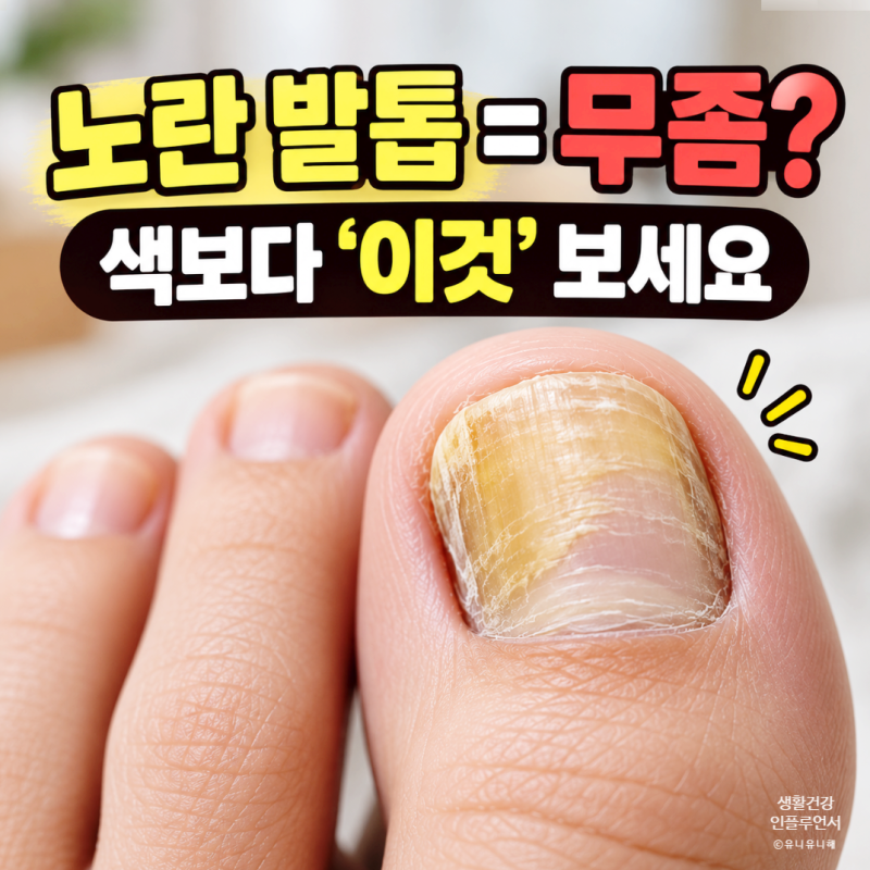 엄지발톱 노랗고 두꺼워졌다면 무좀? 발톱 색깔과 두께로 보는 초기 무좀 증상