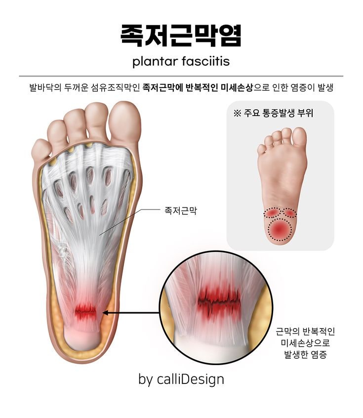 [가을철 족부 건강] "아침 첫발 디딜 때 발바닥 찌릿?" 환절기 산책족 위협하는 '족저근막염' ....