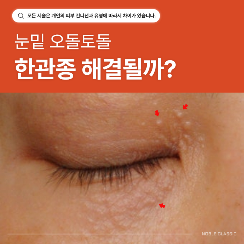동탄 한관종 비립종과 어떻게 다를까요? 차이와 치료에 대해 알아보기