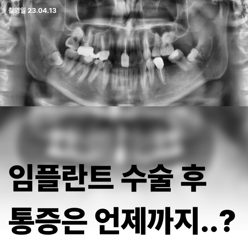 임플란트 수술 후 통증, 정상인가요? (회복 기간)