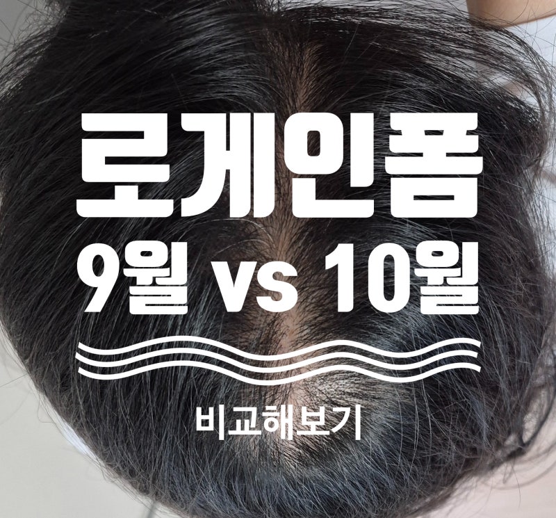 여성 탈모 로게인폼 사용후기 4.(9월 vs 10월)
