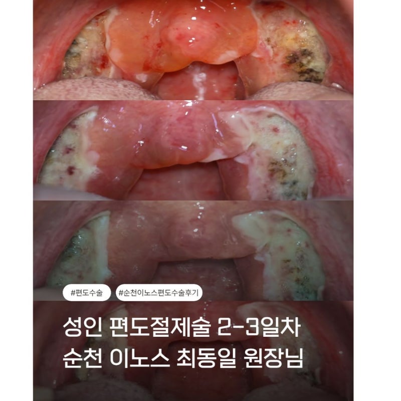 성인 편도절제술 수술 후기 2일차 3일차 퇴원까지 3박4일 걸렸어요(순천 이노스 최동일원장님....