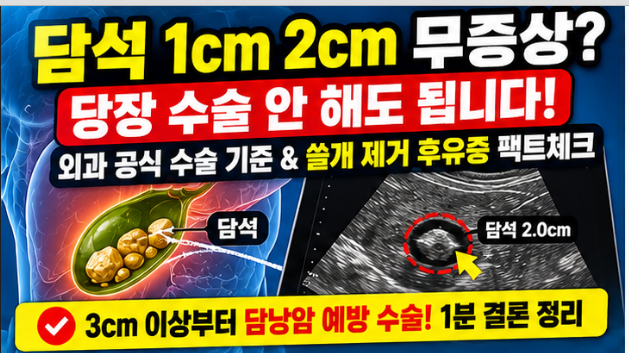 담석 크기 1cm 2cm 무증상 담석 담낭 절제술 수술 기준 쓸개 제거 후유증