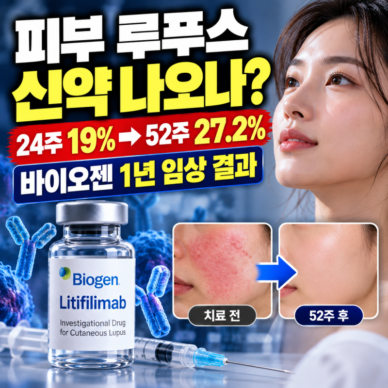 피부 루푸스 치료 새 길 열리나…바이오젠 신약, 1년 지나도 개선 이어졌다
