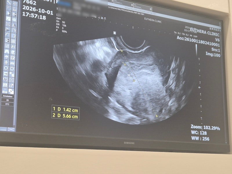 낮은 피검수치 자궁외임신 판정까지, MTX 주사 부작용과 시험관 3차 후기
