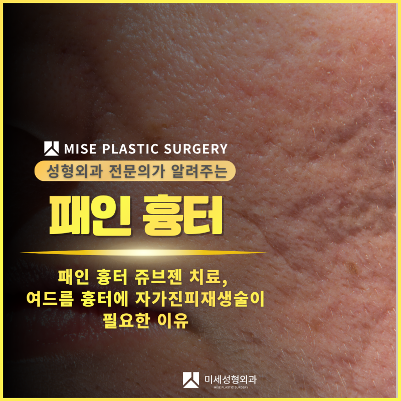 수원 광교 동탄 수지 화성 오산 안산 패인 흉터, 여드름 흉터, 패인 흉터 쥬브젠 치료,여드름 ....