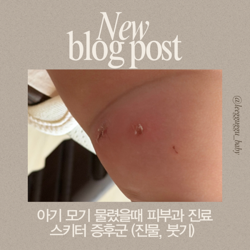 아기 모기 물렸을 때 심하게 붓고 진물생겼을때 스키터 증후군 피부과 진료 후기