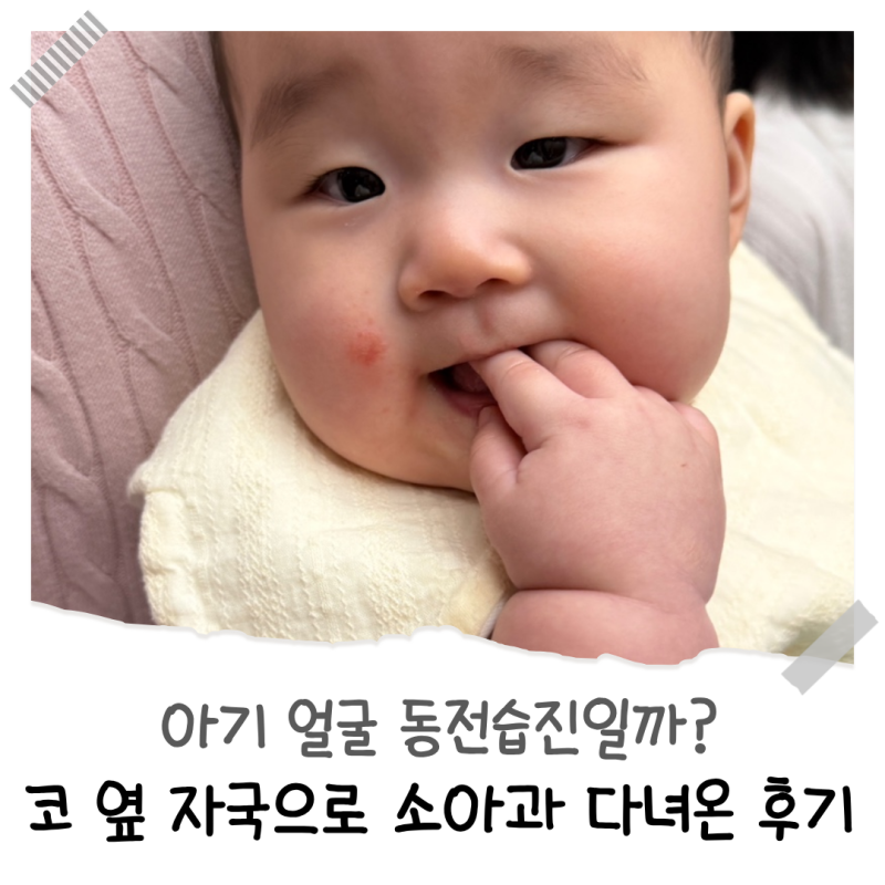 아기 얼굴 동전습진일까? 코 옆 자국으로 소아과 다녀온 후기