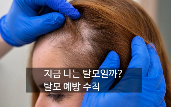 [탈모 진단] 하루 머리카락이 얼마나 빠져야 탈모일까? 기준부터 예방수칙. 탈모에 좋은 ....