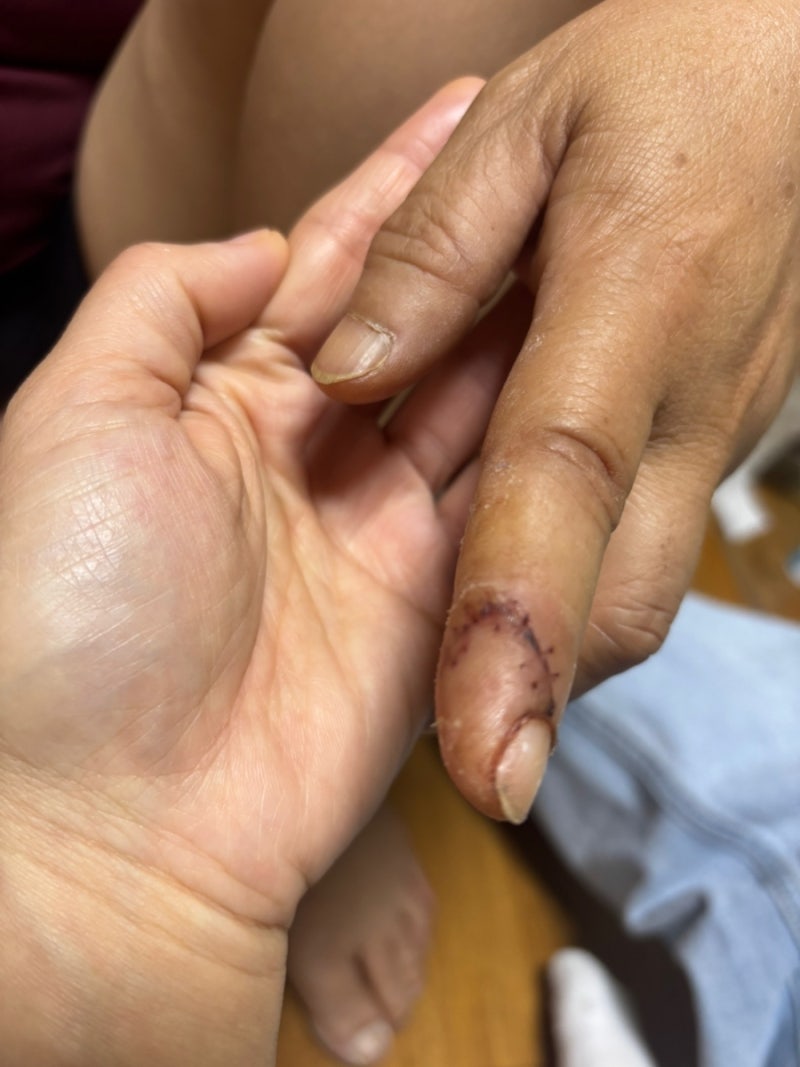 [전국/청주상해보험] 가을 햇밤 까다가 과도에 손 깊게 베여 8바늘 봉합? 단순 창상봉합술 vs ....