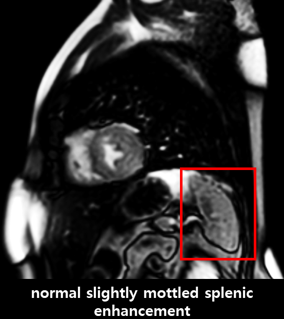 Case Review_276-가슴이 답답함을 호소하는 60대 후반 남성-비장 관류 저하(Splenic switch-off)