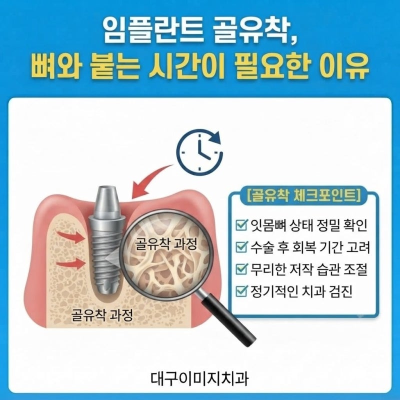 임플란트 골유착, 뼈와 붙는 시간이 필요한 이유｜달서구 임플란트