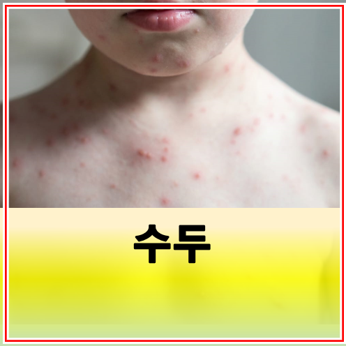 수두 초기 증상 예방접종 전염 방법
