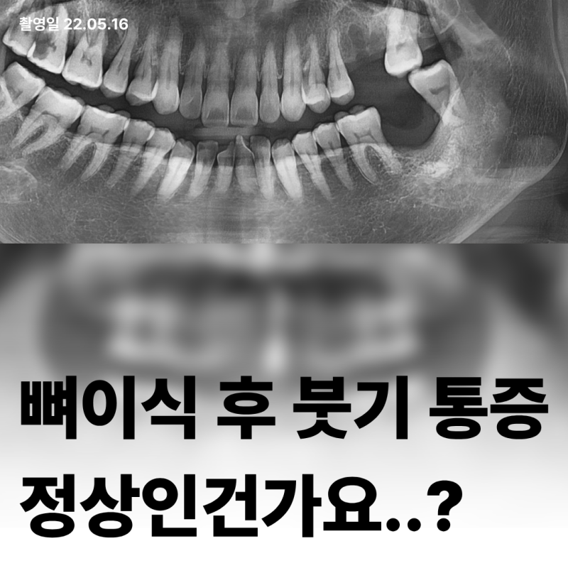 임플란트 수술 후 붓기 멍은 왜?