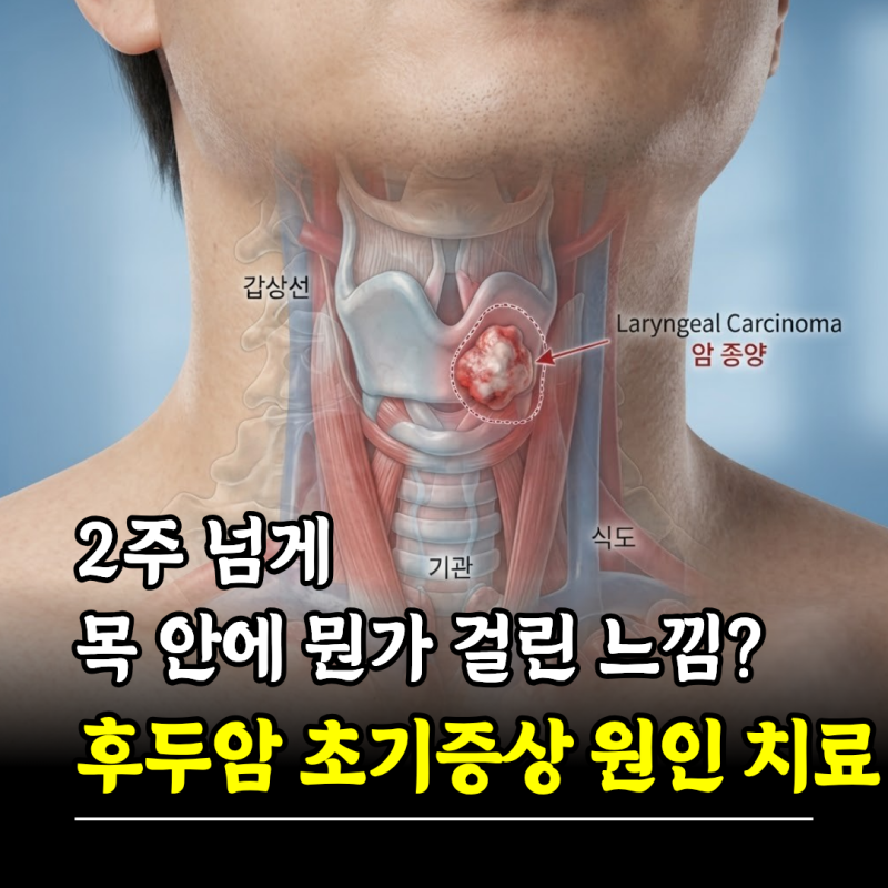 2주 넘게 목 안에 뭔가 걸린 느낌? 후두암 초기증상 원인 치료