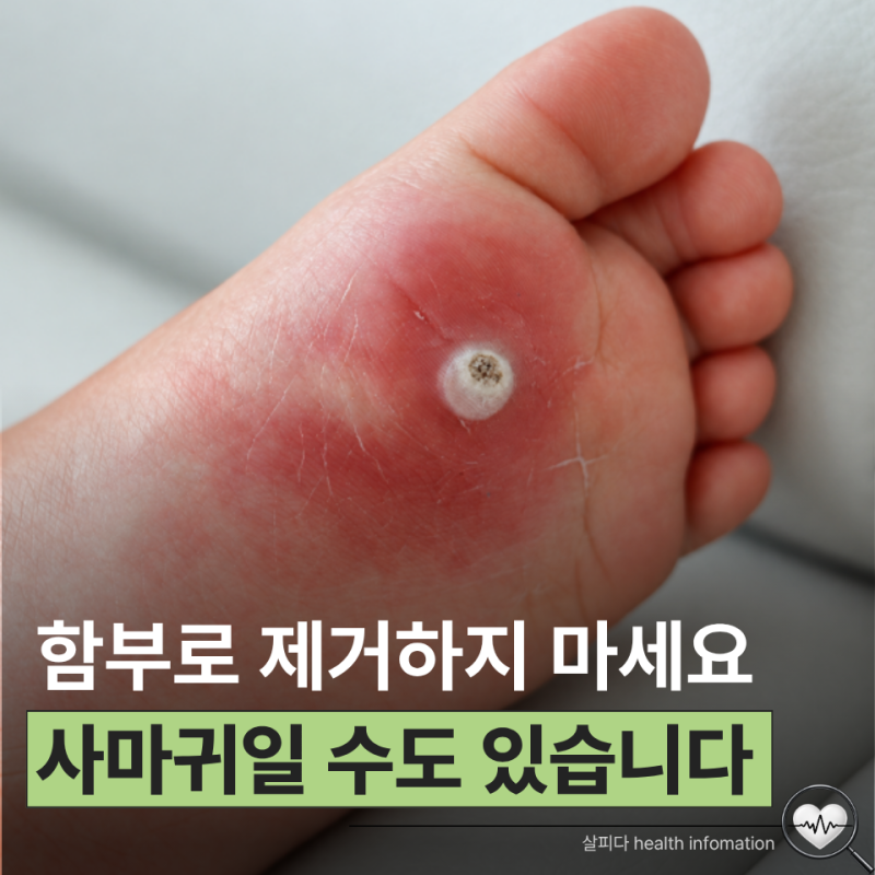 발바닥 딱딱하다면 티눈일까 사마귀일까? 잘못 건드리면 번질 수도