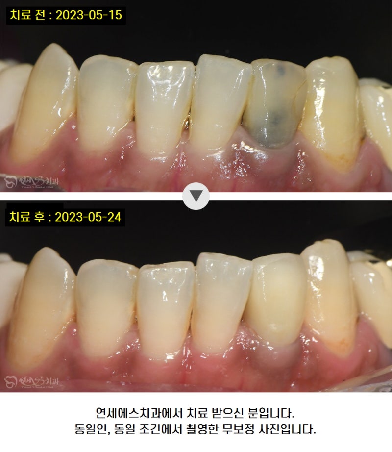 앞니 변색 충치 신경치료 후 까만색, 지르코니아 크라운