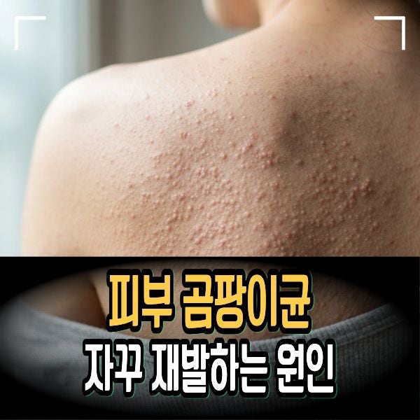 피부 곰팡이균 연고 바를 때만 낫고 자꾸 재발하는 원인