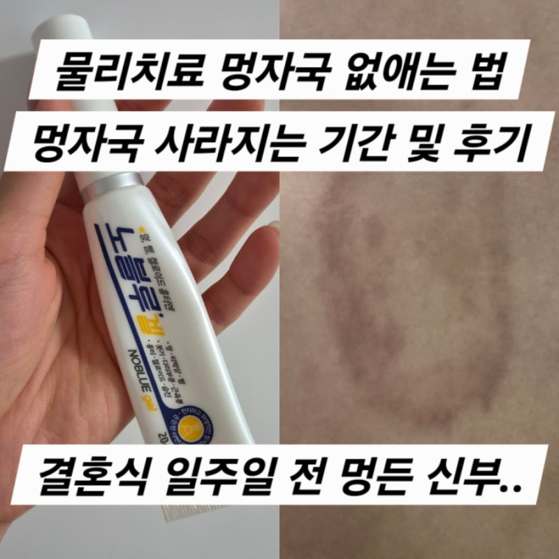전기 물리치료 멍자국 사라지는 기간 / 멍자국 빨리 없애는 꿀팁 / 본식 전 멍자국