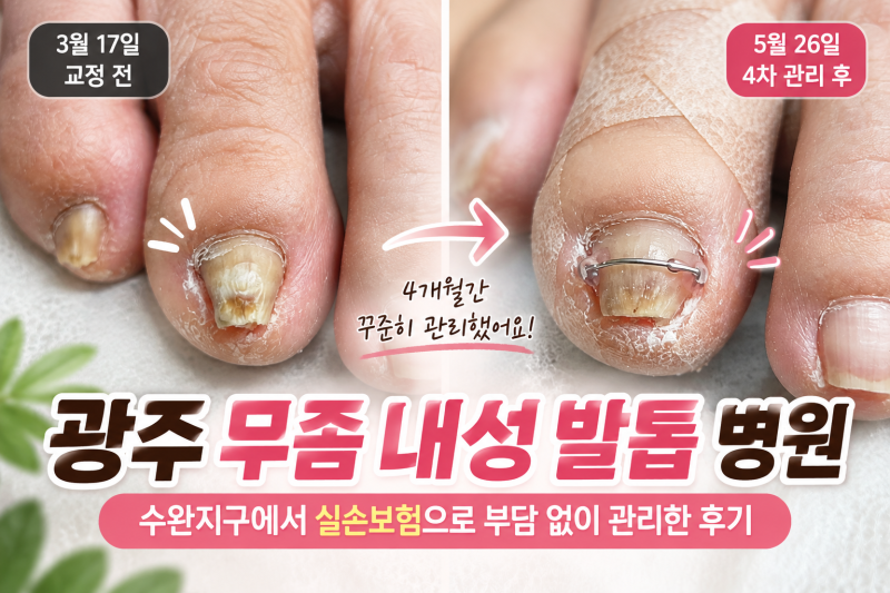 광주 무좀 내성 발톱 병원 수완지구 엄마와 꾸준히 관리한 과정
