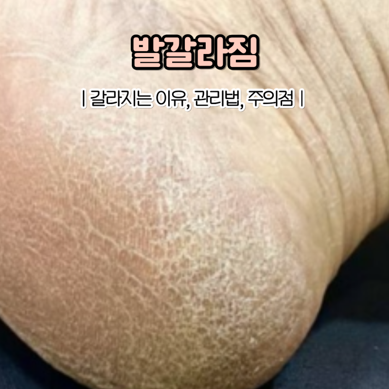 발뒤꿈치 갈라짐 원인 발뒤꿈치 각질 심한 이유