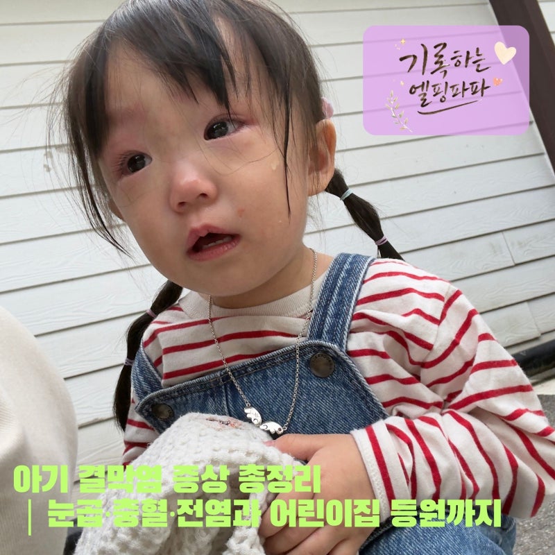 아기 결막염 증상 총정리｜눈곱·충혈·전염과 어린이집 등원까지