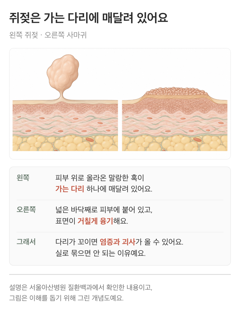 쥐젖 사마귀 차이, 목에 생긴 말랑한 돌기 떼도 될까?