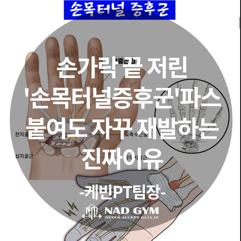 손가락 끝 저린 '손목터널증후군..'파스 붙여도 자꾸 재발하는 진짜이유(케빈PT팀장)