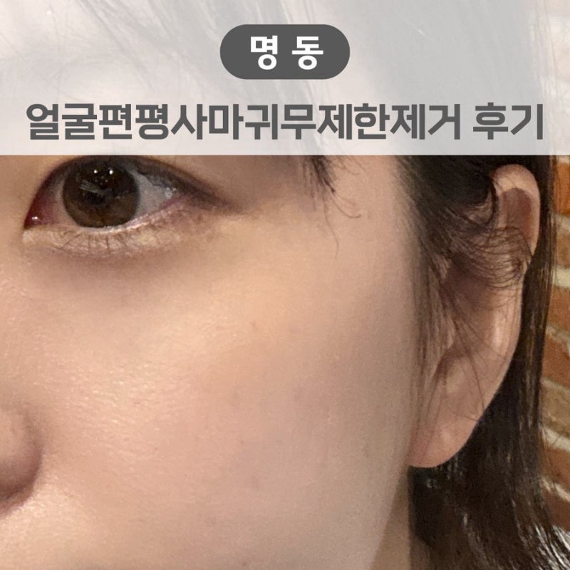 서울편사성지추천 얼굴편평사마귀무제한제거후기, 눈밑 편평사마귀 깔끔하게 제거한 후기