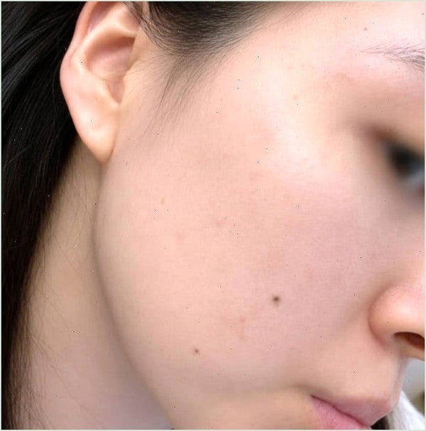 수란트라 연고 궁금해하신다면? (+요즘 변화)