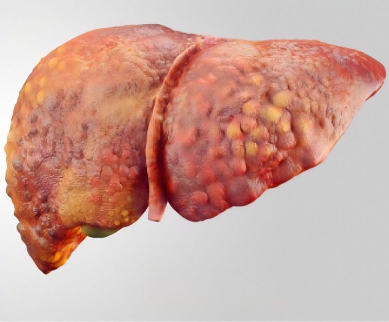 지방간의 치료와 관리(Treatment and management of fatty liver disease)