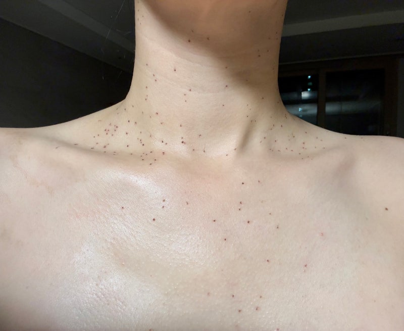 부산 편평사마귀 제거 후기｜ 4일차까지 직접 겪어보니