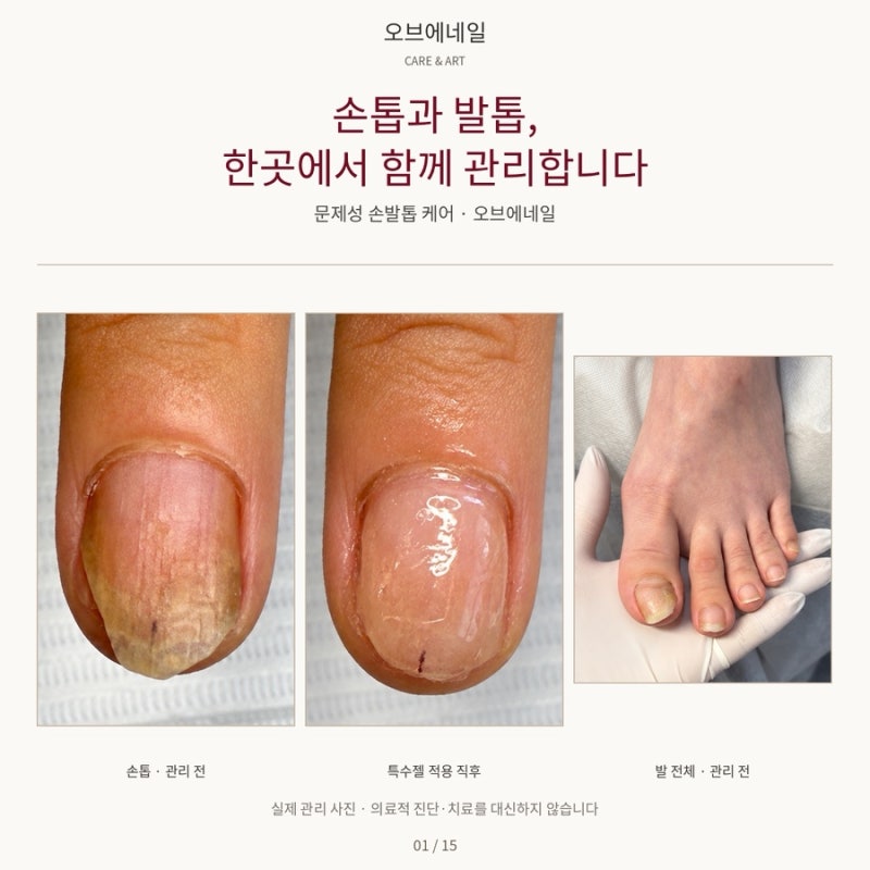 손톱은 갈라져 아프고 발톱은 한쪽으로 말려요｜대구 문제성 손톱·문제성 발톱 관리 오브에....