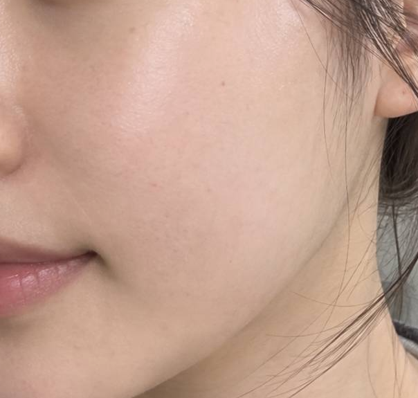 고우리 부작용이 걱정된다면 시술 전 확인해야 할 것