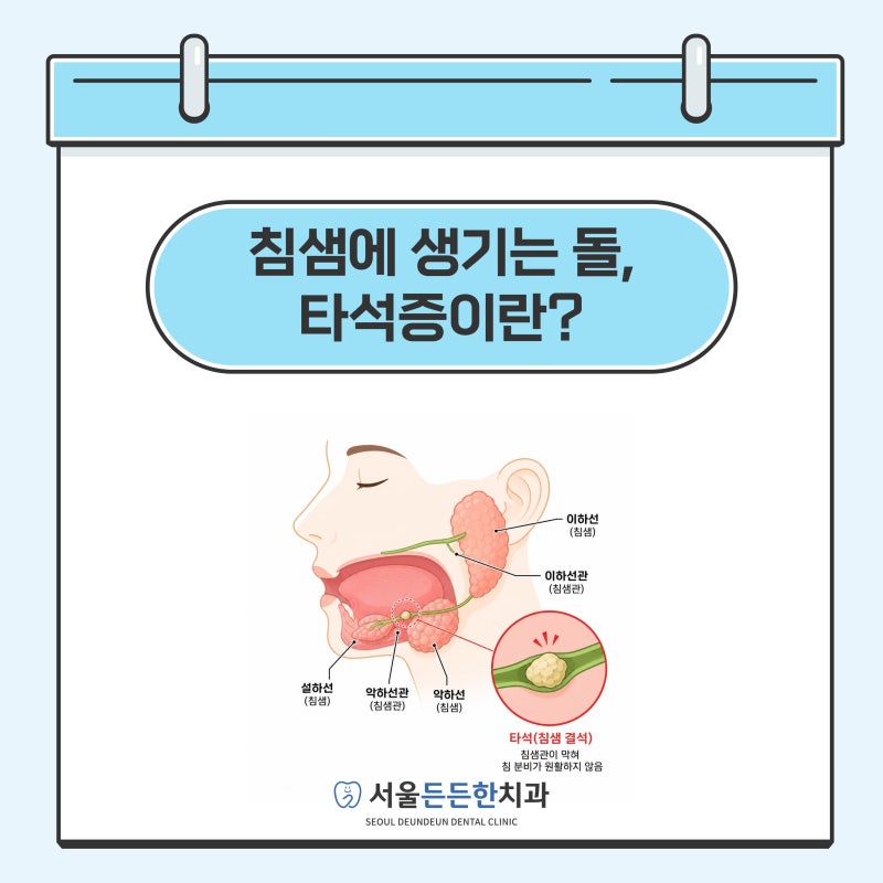 침샘에 생기는 돌, 타석증이란? - 군자역 치과 서울든든한치과