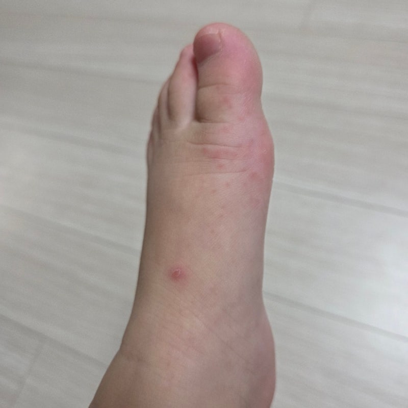 아기 수족구 초기증상 수포 어른 전염 잠복기 원인 약 금방 낫기