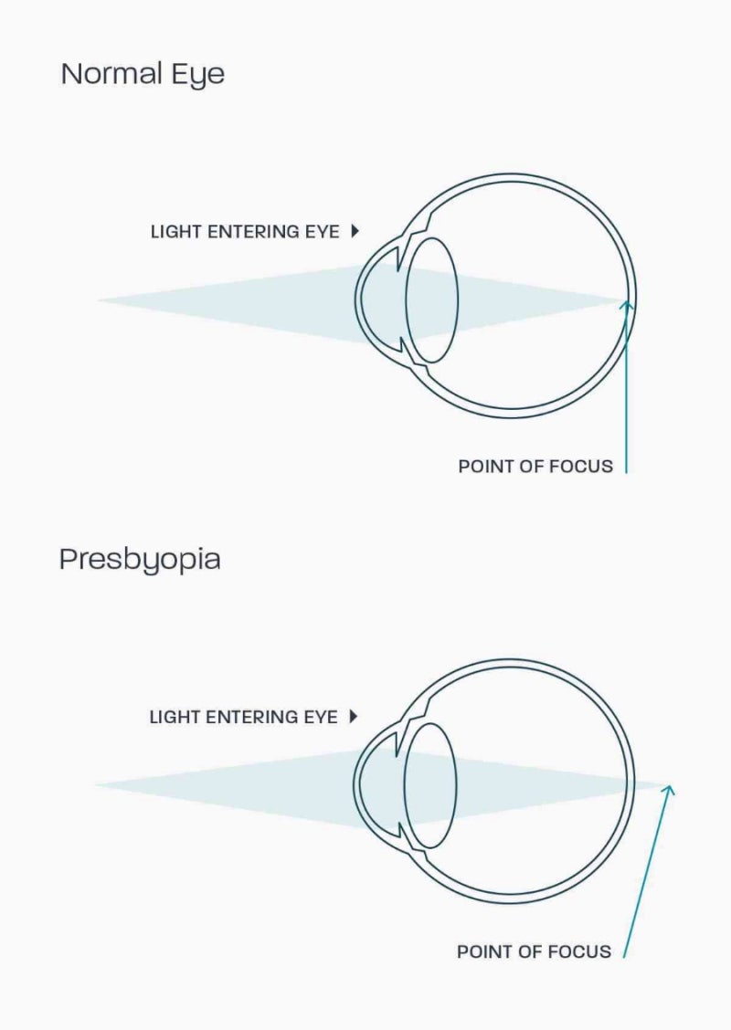 노안 Presbyopia: 노안·백내장·각막·굴절수술 의료진 & 의료기관 데이터북