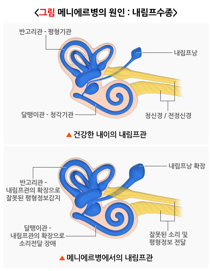 50대 후반 메니에르진단 관리방법?