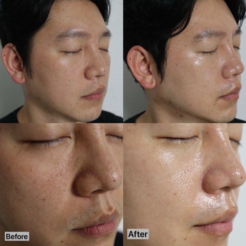 악센다 루티너 삭제밤 1회 효과, 하룻밤 바르고 잔 남편 블랙헤드·모공 내돈내산 후기