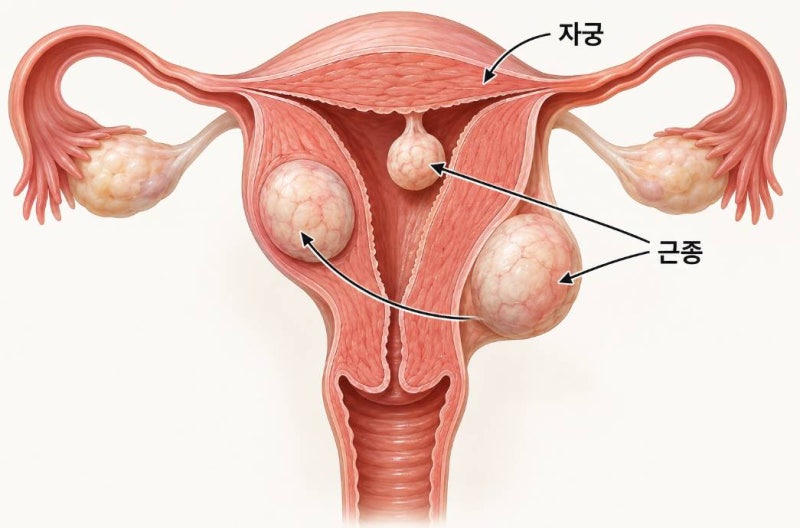 자궁근종 크기 키우지 않으려면? 식탁에서 바꿀 수 있는 것들