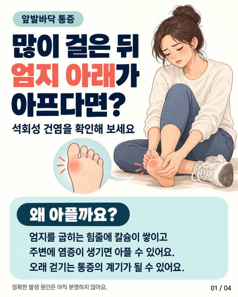 많이 걸은 뒤 앞쪽 발바닥이 아프다면? 엄지발가락 아래 ‘석회성 건염’