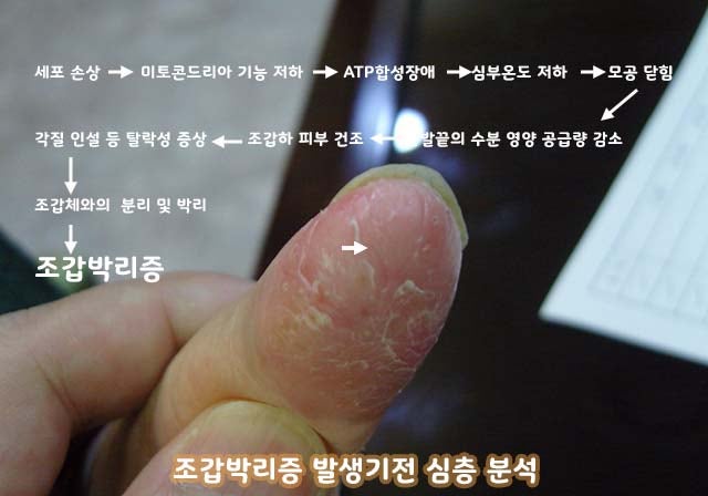 조갑박리증, 심부온도를 높여라!!