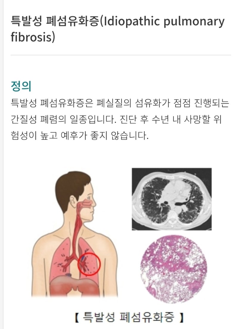 특발성폐섬유화증(Idiopathic Pulmonary Fibrosis, IPF)은 원인을 알 수 없이 폐실질의 간질 조직에 지....