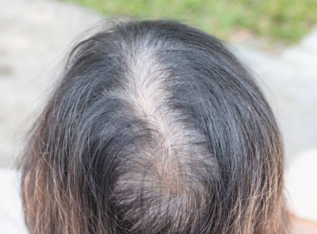 다낭성난소증후군 여성 탈모 원인과 이노시톨 복용 효과 및 선택법