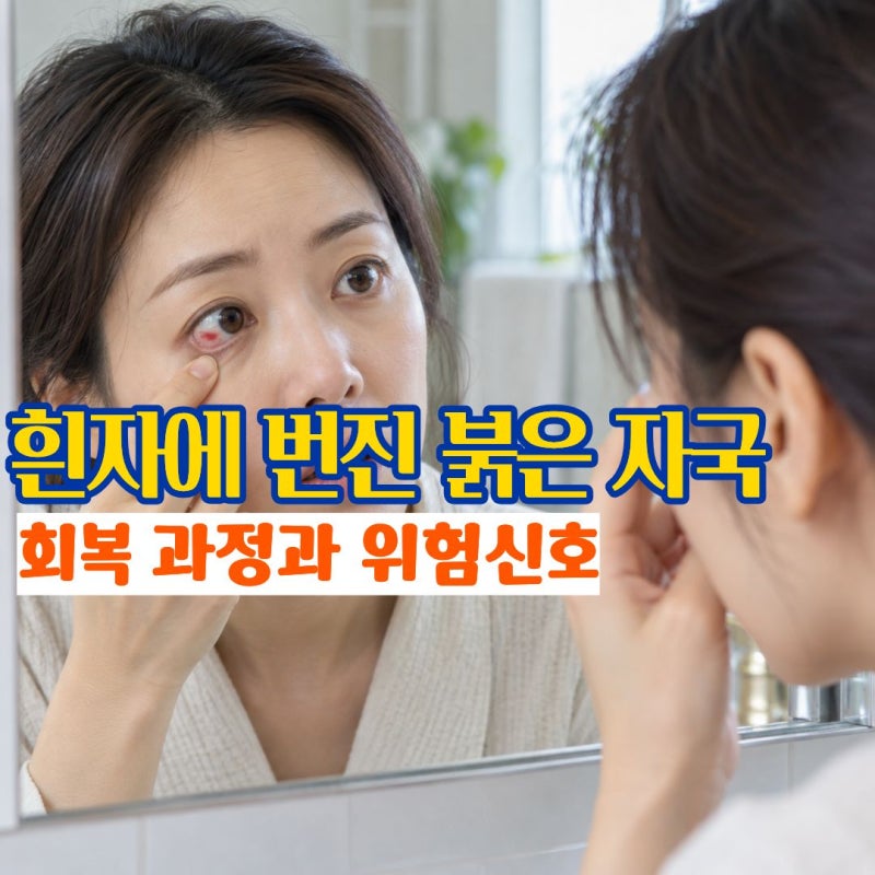 결막하출혈 증상 눈실핏줄터짐처럼 보일 때 치료와 회복과정