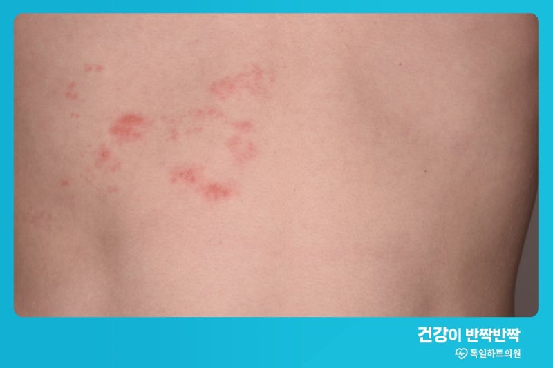 대상포진 전염성 있나요 ? 기간 잠복기까지 알아보아요