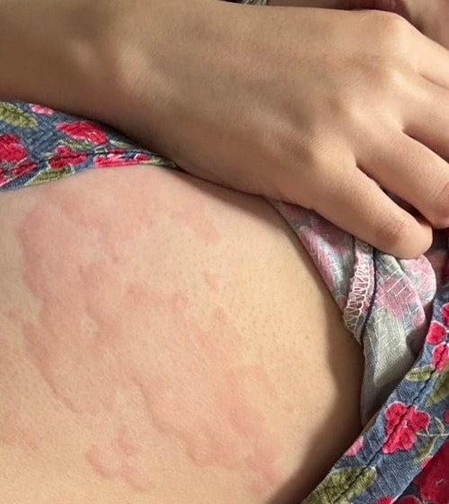면역력 저하로 전신 두드러기가 생겼다?온몸이 가렵고 붉어져요