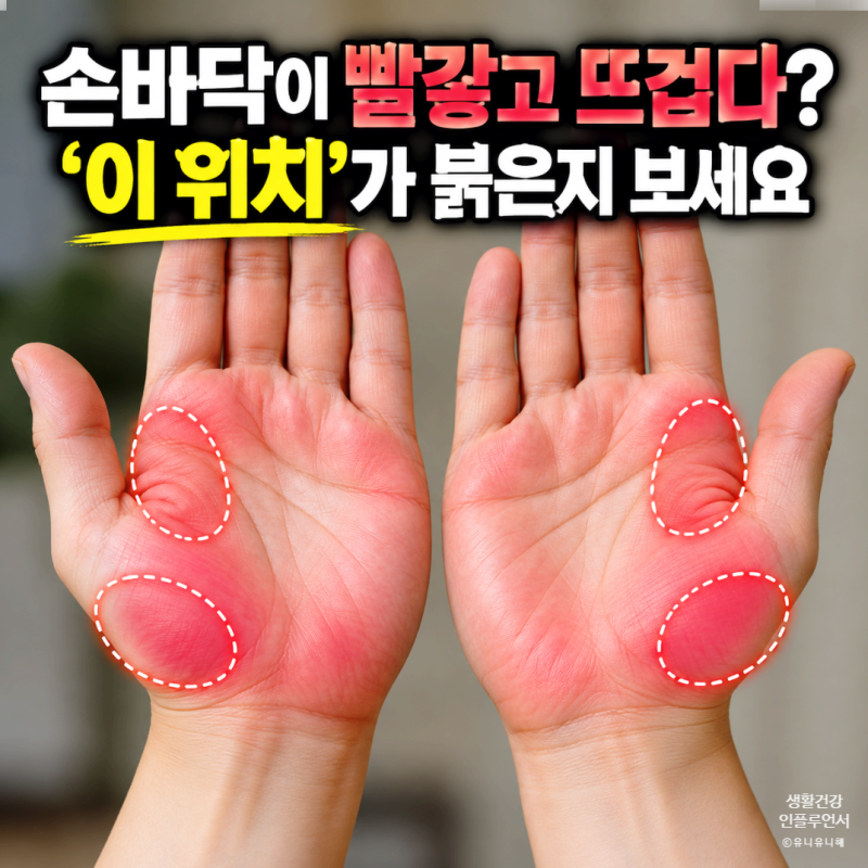 빨갛고 뜨거운 손바닥 열감, 수장홍반 증상? 간 기능 이상과 구별법