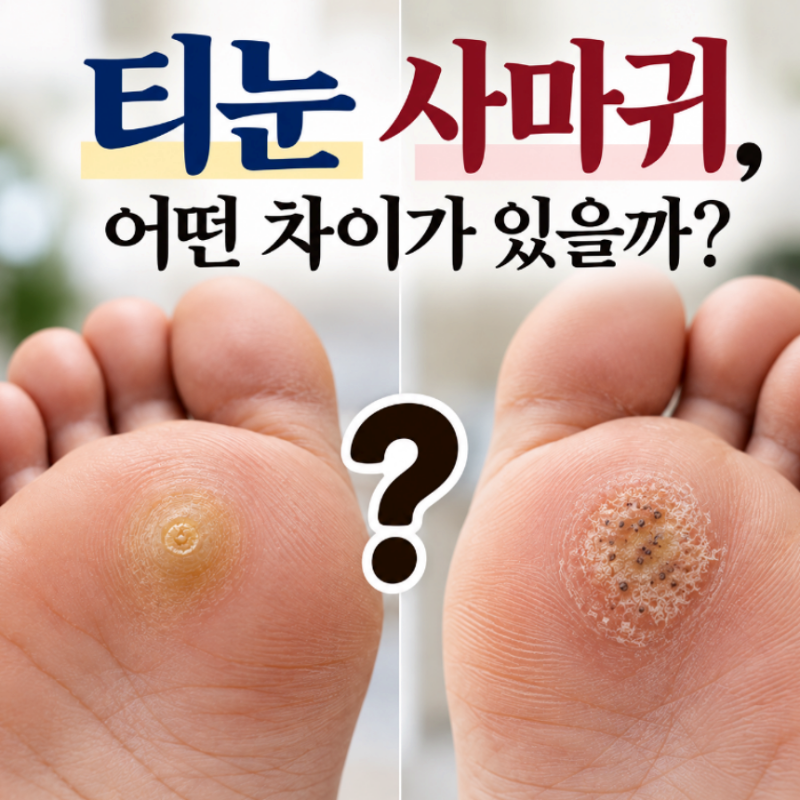 티눈 사마귀 차이, 어떻게 구분할까?